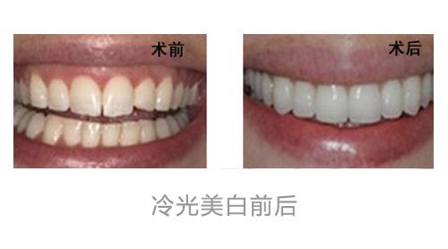 冷光美白牙齿技术的优点